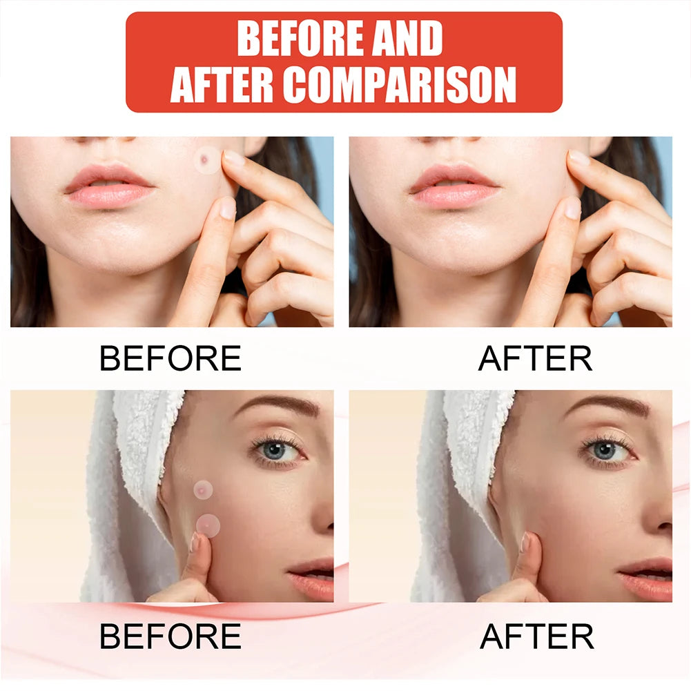 Pimple Patches (durchsichtig)